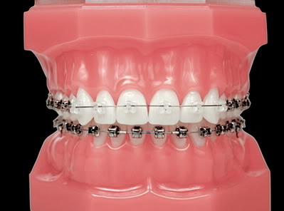 Металлическая система на нижних зубах