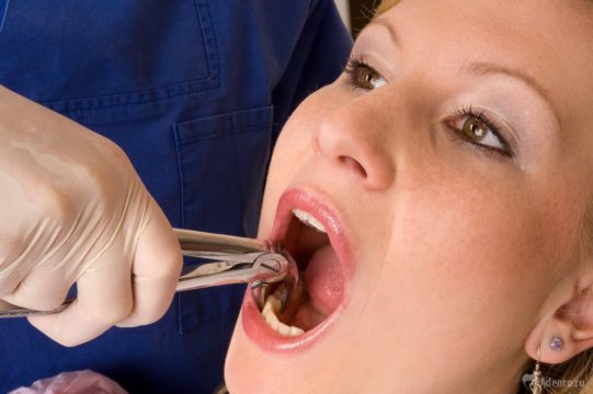 Удаление зуба у стоматолога