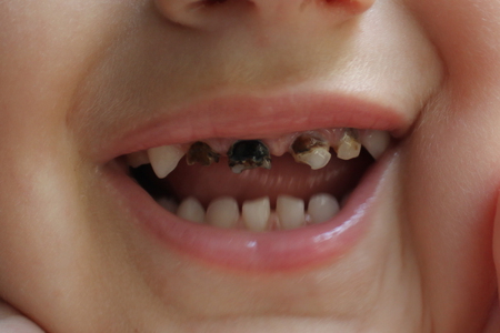Детский кариес молочных зубов