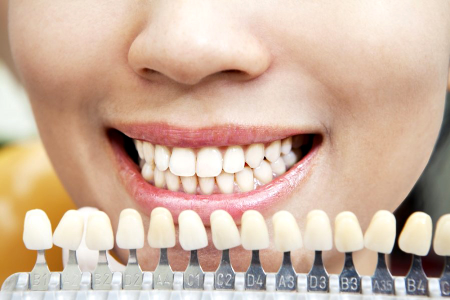 отбеливание зубов сколько тонов