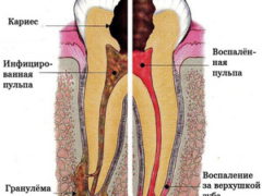 Причины боли в корне зуба