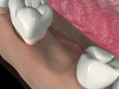 Долго ли заживает десна после удаления зуба?