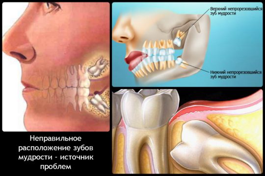 Зуб мудрости - частая причина зубной боли