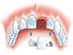 Какие виды зубных протезов и мостов существуют?