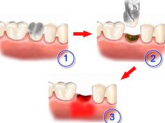 Почему может возникнуть альвеолит после удаления зуба?