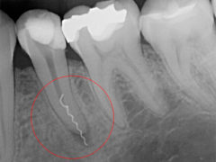 Почему после удаления нерва может болеть зуб при нажатии?