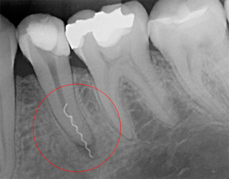 Удаление нерва зуба фото