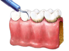 Профессиональная чистка зубов в стоматологии