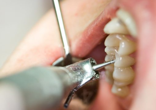 Лечение пораженных участков зубов фото
