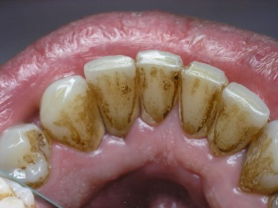 Зубные отложения у курильщиков