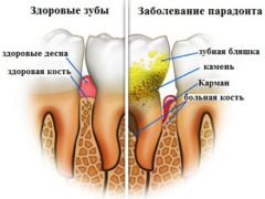 Способы удаления зубного камня в домашних условиях