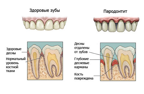 Здоровые зубы и пародонтит