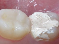 Если поставили мышьяк, а зуб продолжает болеть — что делать?