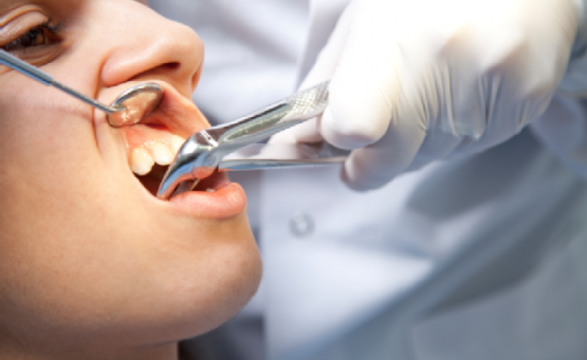 Удаление зуба в поликлинике