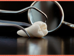 Почему возникает белый налет после удаления зуба?