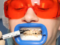 Метод отбеливания зубов Zoom 4