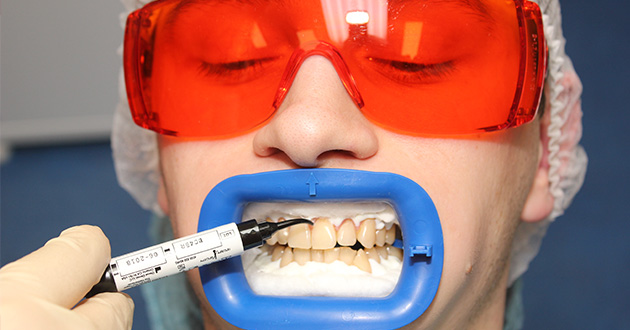 Обработка зубов перед отбеливанием