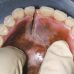 Как и чем можно склеить зубной протез в домашних условиях?