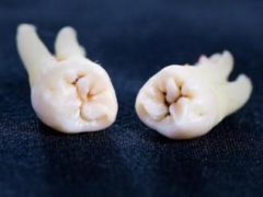 Сколько будет болеть зуб после удаления?