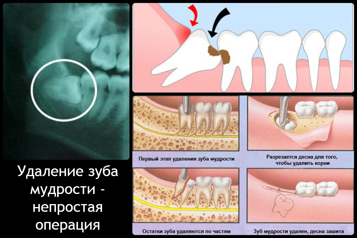 Сложное удаление зуба Томск Встречная Базальная имплантация зубов Томск Баумана