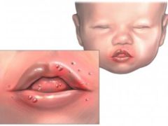 Чем и как лечить язвочки во рту у ребенка?
