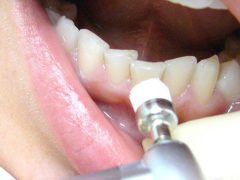 Описание ультразвукового отбеливания зубов