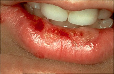 Воспаление на губах