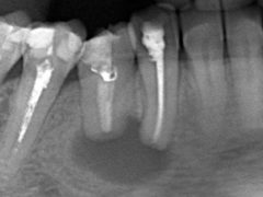 Операция по удалению кисты зуба