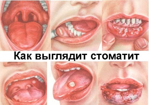 Язвочки на разных частях слизистой рта фото