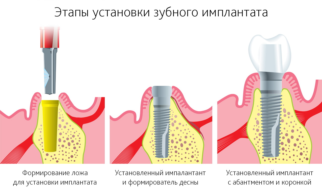 Схема установки имплантов зубов на нижней челюсти