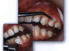 Средства помогающие против зубного камня