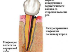 Как проходит процедура удаления корня зуба?