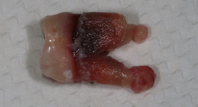 Зуб после удаления