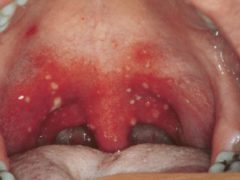 Методы лечения стоматита в горле