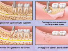 Как проводится операция по сложному удалению зуба?