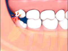 Симптомы прорезания зуба мудрости