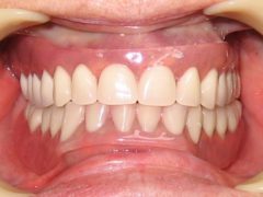 Современные съемные зубные протезы — обзор конструкций