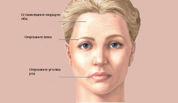 Воспаление лицевого нерва фото симптомы и лечение