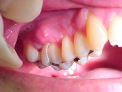 Причины и лечение воспаления надкостницы зуба