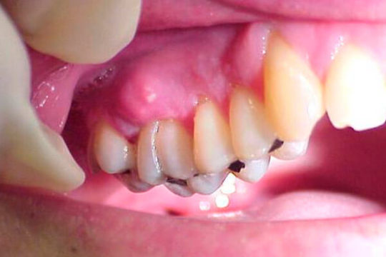 надкостница зуба