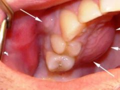 Причины появления и методы лечения кисты челюсти