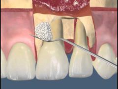 Что такое лоскутная операция в стоматологии?