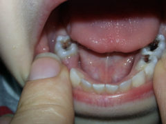 Требуется ли лечение пульпита молочных зубов и как оно проводится?