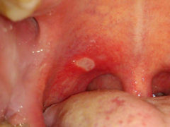 Почему возникает стоматит в горле и как его лечить?
