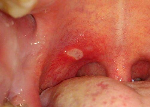 Стоматит в горле у ребенка фото-1