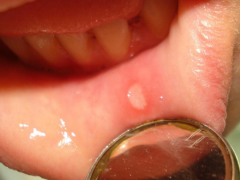Распознаем признаки заболевания — афты во рту у детей