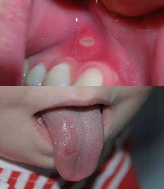 Герпесные пузырьки на языке и в горле у ребенка фото