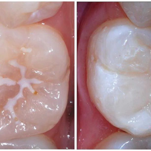 герметизация зубов у детей что это фото